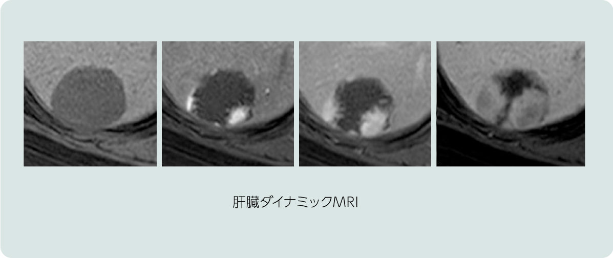 肝臓MRI画像