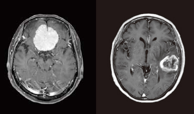 脳のCT画像